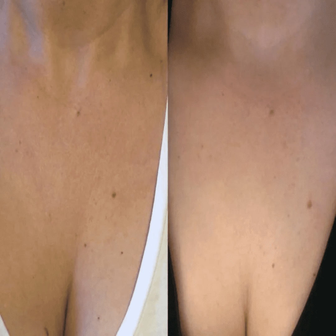 Wiederverwendbare Anti Falten Brust Pad Silikon Transparent Entfernung  Patch Gesicht Hautpflege Anti Aging Brust Heben Brust Patch Flesh -  AliExpress